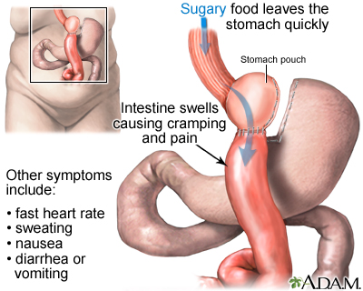 Dumping syndrome