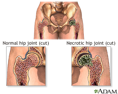 Aseptic necrosis