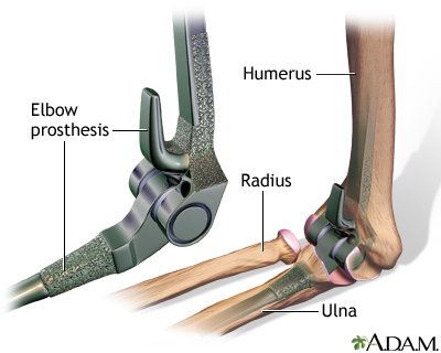 Elbow prosthesis