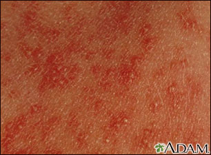 Erythema toxicum neonatorum - close-up