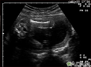 Ultrasound, normal fetus - femur measurement