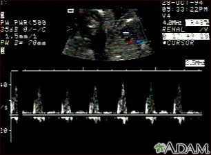 Ultrasound, normal fetus - heartbeat