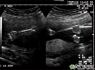 Ultrasound, normal fetus - arms and legs