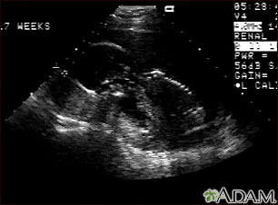 Ultrasound, normal fetus - profile view