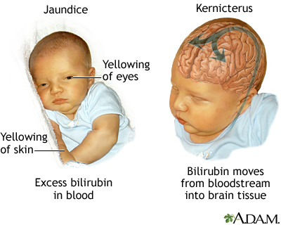 Kernicterus