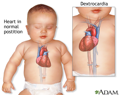 Dextrocardia