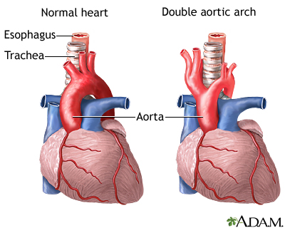 Double aortic arch