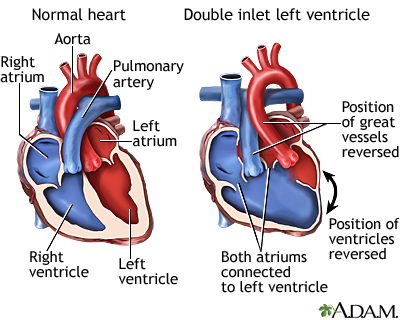 Double inlet left ventricle