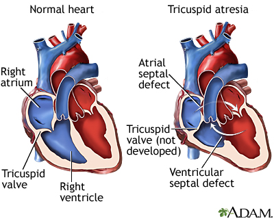 Tricuspid atresia