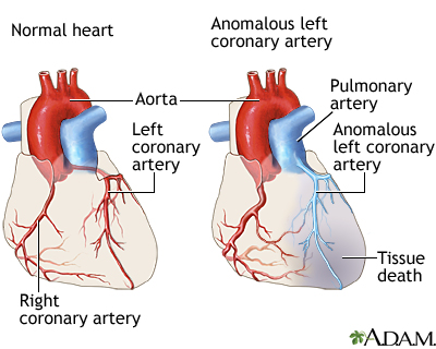 Anomalous left coronary artery