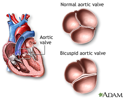 Bicuspid aortic valve