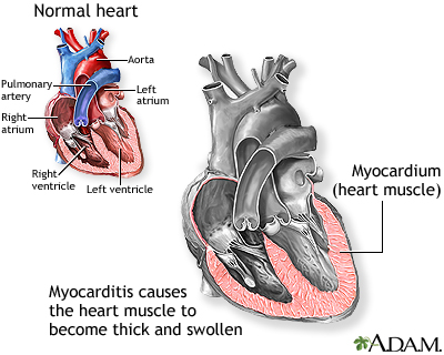 Myocarditis