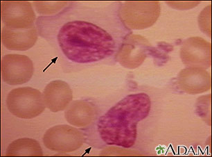 Mononucleosis, photomicrograph of cell