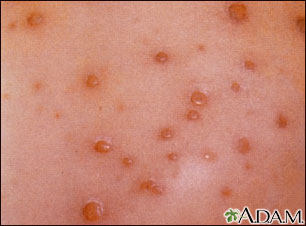 Chickenpox-closeup