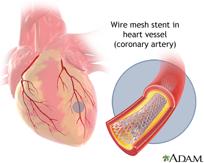 Coronary artery stent