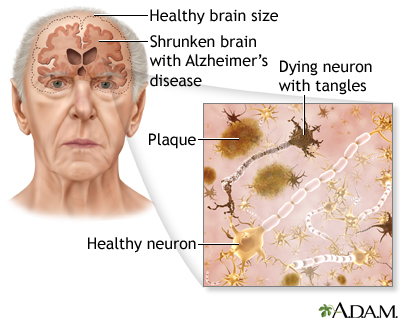 Alzheimer's disease