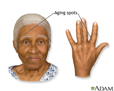 Aging spots