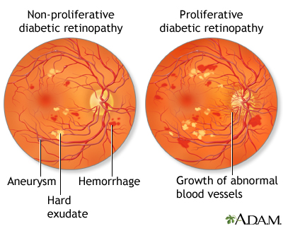 Diabetic retinopathy