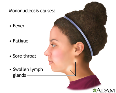 Infectious mononucleosis