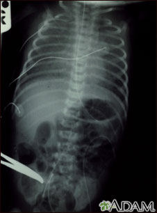 Totally anomalous pulmonary venous return, X-ray