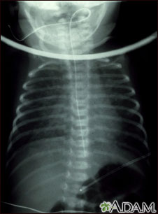 Totally anomalous pulmonary venous return, X-ray