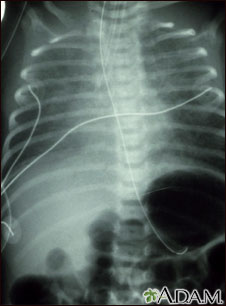 Totally anomalous pulmonary venous return, X-ray