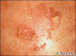 Actinic keratosis - close-up