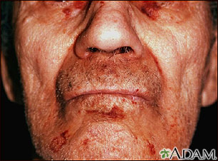 Amyloidosis on the face