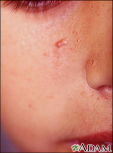 Tuberous sclerosis, angiofibromas  - face