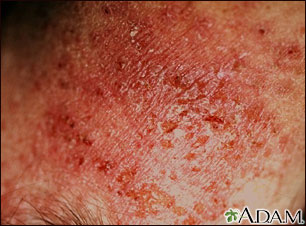 Dermatitis, close-up of allergic contact