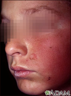 Dermatitis, contact on the cheek