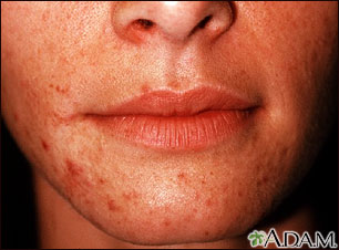 Dermatitis, perioral