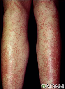 Drug rash, Tegretol