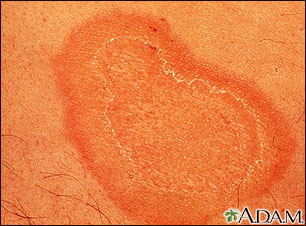 Erythema annulare centrifugum - close-up