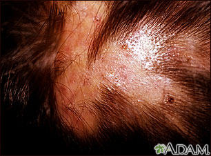 Folliculitis, decalvans on the scalp