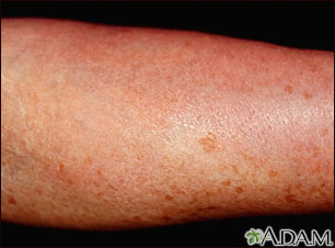 Mastocytosis, diffuse cutaneous