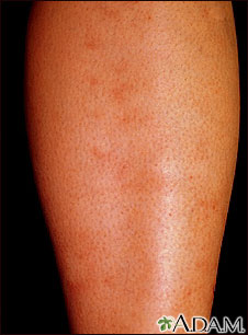 Polyarteritis, microscopic on the shin