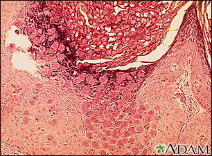 Molluscum, microscopic appearance