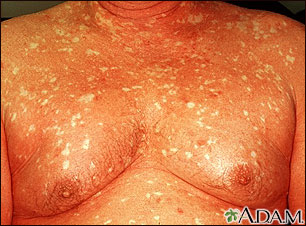 Pityriasis rubra pilaris on the chest