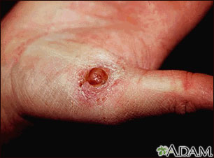 Pyogenic granuloma on the hand