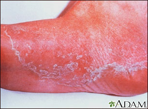 Athlete's foot, tinea pedis