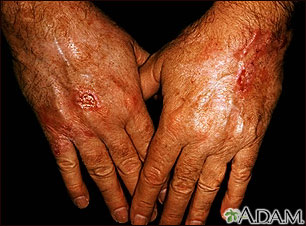 Skin cancer, squamous cell on the hands