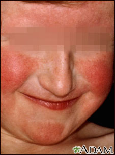 Dermatitis, atopic on a young girl's face