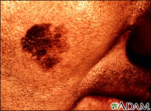 Skin cancer, close-up of lentigo maligna melanoma