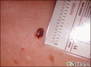 Skin cancer, close-up of level III melanoma