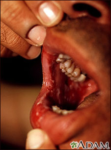 Pemphigus, vulgaris - lesions in the mouth