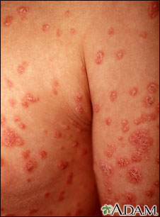 Psoriasis, guttate on the arms and chest