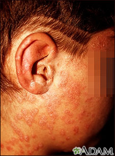 Psoriasis, guttate on the cheek