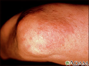 Granuloma, annulare on the elbow