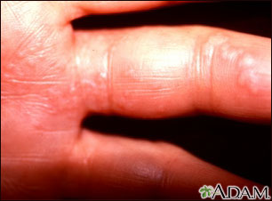 Herpes zoster (shingles) on the hand and fingers